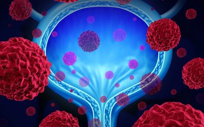 Nivolumab/Ipilimumab Shows Improved Benefit in Urothelial Carcinoma