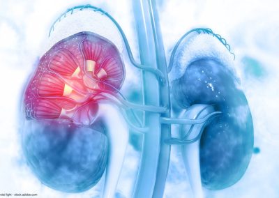 Rates of CVD Rising in Metastatic RCC Patients, Especially Males – U.S. Medicine